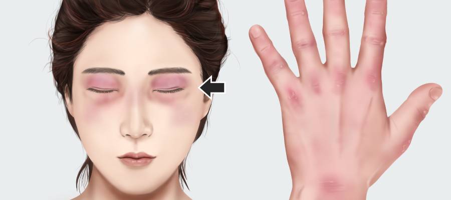 Dermatomiyozit, kas iltihabı ve cilt döküntüleriyle karakterize olan nadir otoimmün hastalıktır.
