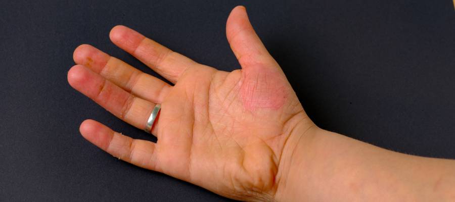 Dermatomiyozit bağışıklık sisteminin yanlışlıkla vücuda zarar vermesi nedeniyle kaslarda güçsüzlük ve ciltte kızarıklıklar oluşturabilir.