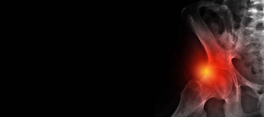 Kalça labrum yırtığı, genellikle sporcularda aşırı yüklenme nedeniyle oluşur.