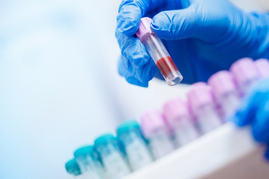 Karaciğer Fonksiyon Testi Nedir? Neden Yapılır?